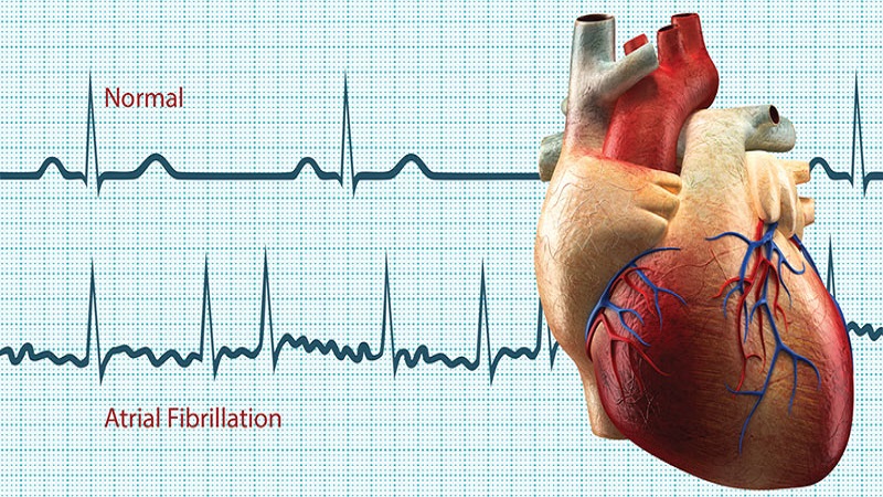 فیبریلاسیون دهلیزی