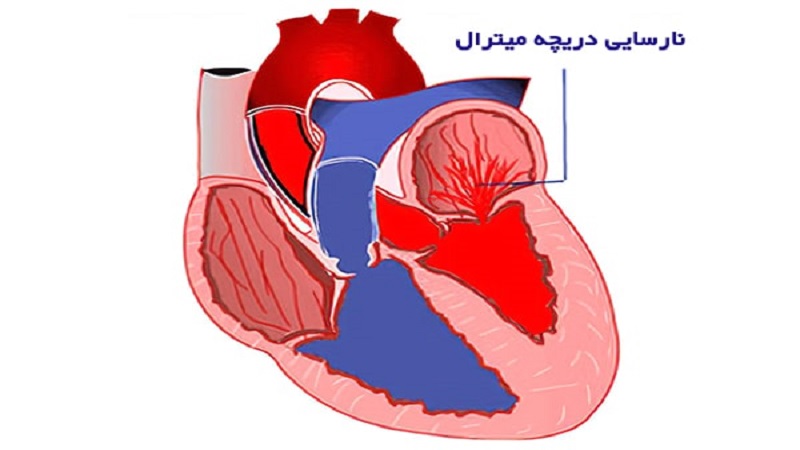 خطرات نارسایی دریچه میترال | متخصص قلب اصفهان