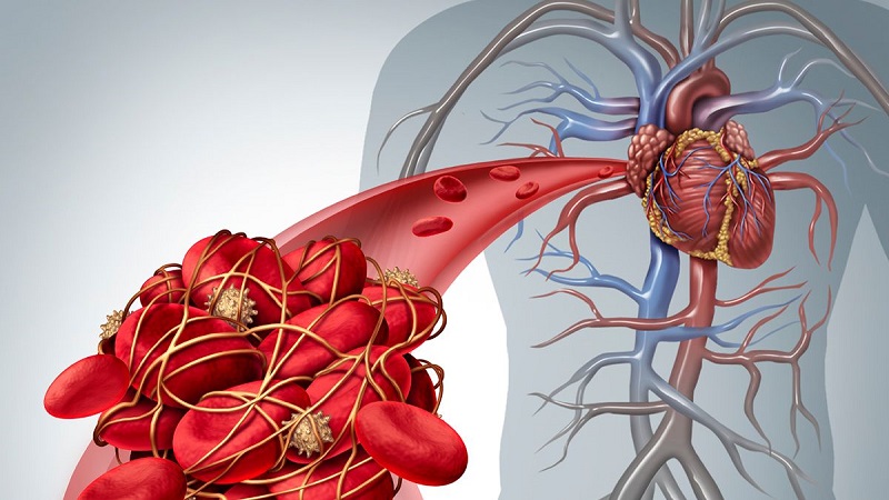 جلوگیری از ترومبوز وریدی عمقی با تغذیه مناسب | متخصص قلب اصفهان