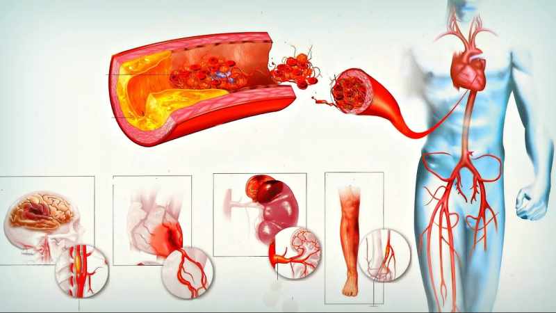 روش های درمانی تصلب شرایین | متخصص قلب اصفهان