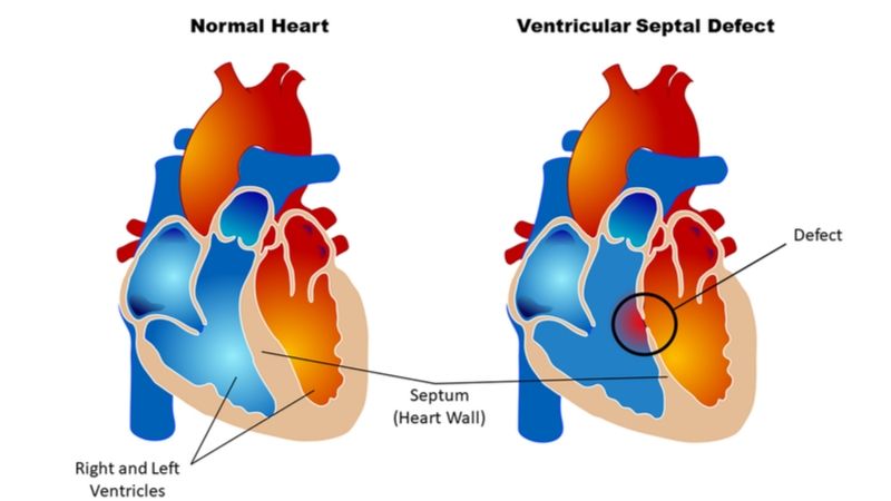 جراحی جهت درمان نقص دیواره بین بطنی یا VSD | متخصص قلب اصفهان