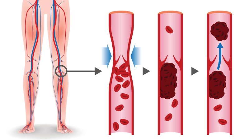 اقدامات درمانی لخته های عمقی | بهترین متخصص واریس اصفهان | درمان واریس اصفهان