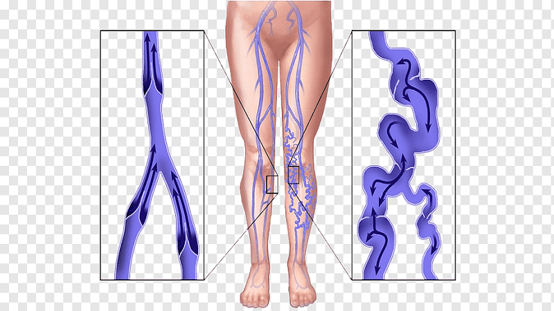 آیا امکان پیشگیری از بروز واریس پا وجود دارد؟ | بهترین متخصص واریس اصفهان