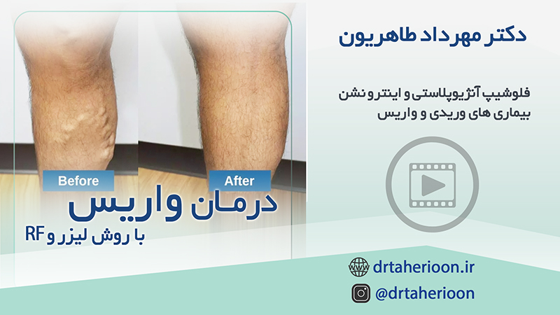 نمونه درمان واریس با روش لیزر و RF|متخصص واریس اصفهان