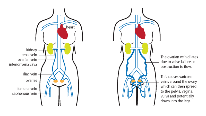 علائم و عوارض واریس لگن و سندرم احتقان لگنی | بهترین متخصص واریس اصفهان