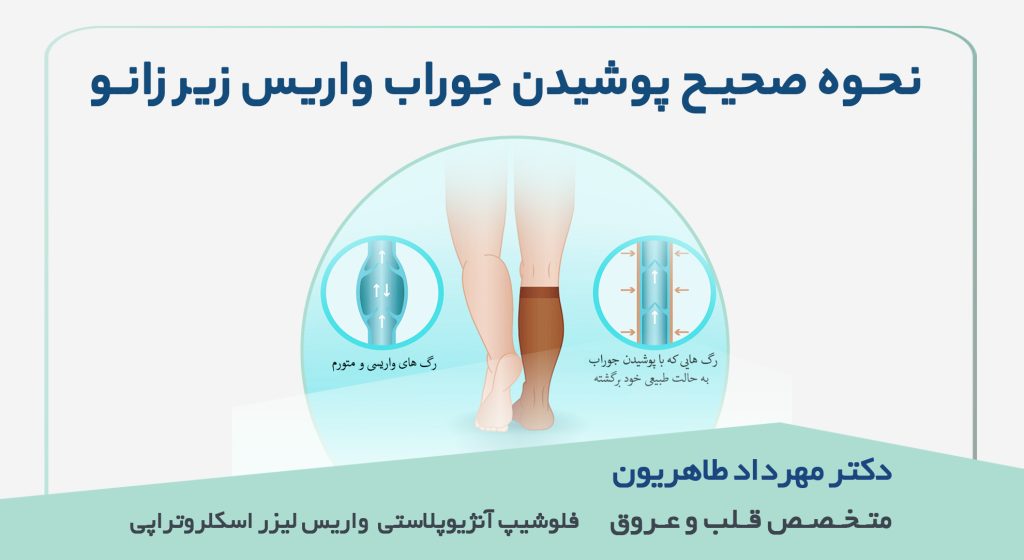 نحوه صحیح پوشیدن جوراب واریس زیر زانو|درمان واریس در اصفهان