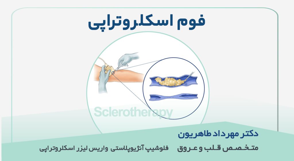 فوم اسکلروتراپی چیست | درمان واریس در اصفهان