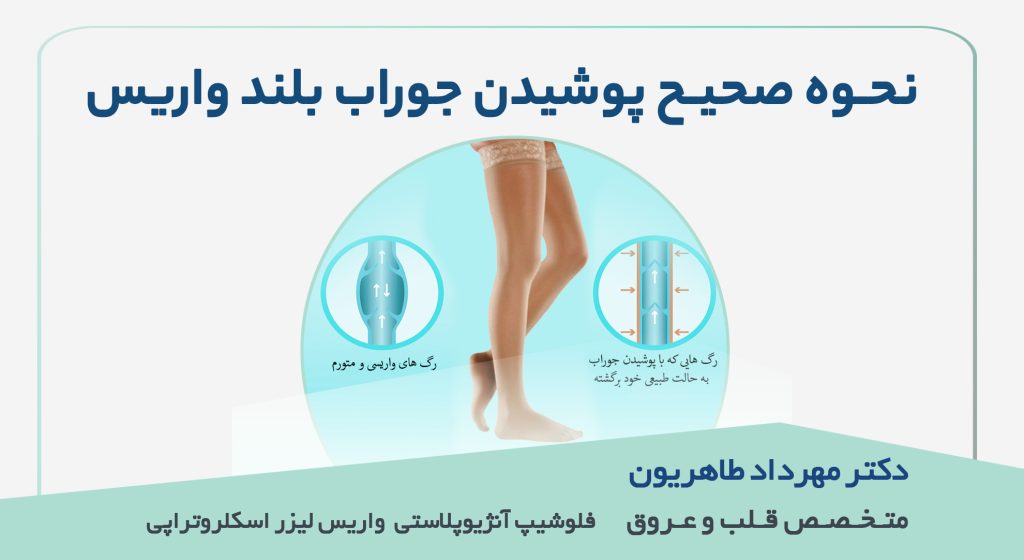 نحوه صحیح پوشیدن جوراب واریس بلند|بهترین متخصص واریس اصفهان