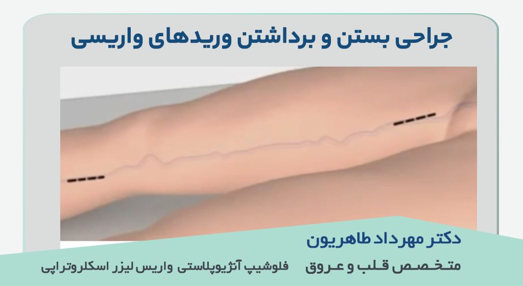 جراحی بستن و برداشتن وریدهای واریسی|متخصص واریس اصفهان