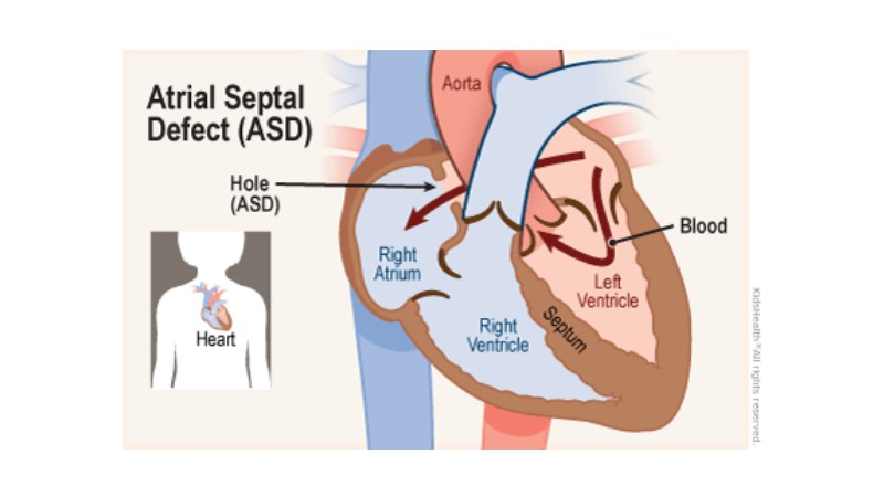 انواع نقص سپتوم دهلیزی یا ASD | متخصص قلب اصفهان