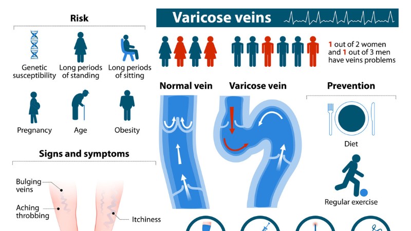 تاثیر ژنتیک در بروز رگ‌های واریسی | بهترین متخصص واریس اصفهان