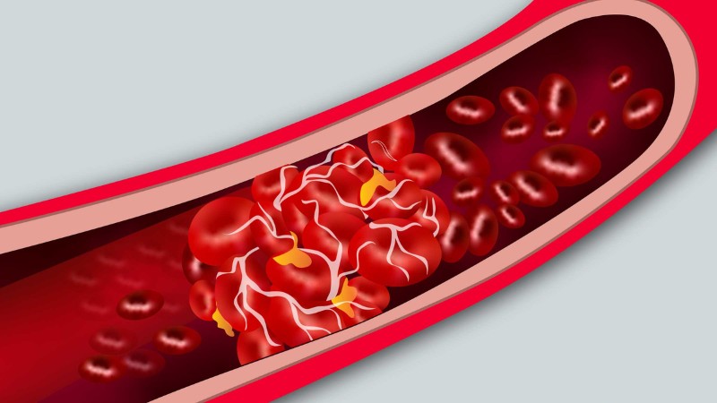 خطرات و عوارض لخته شدن خون | متخصص قلب اصفهان