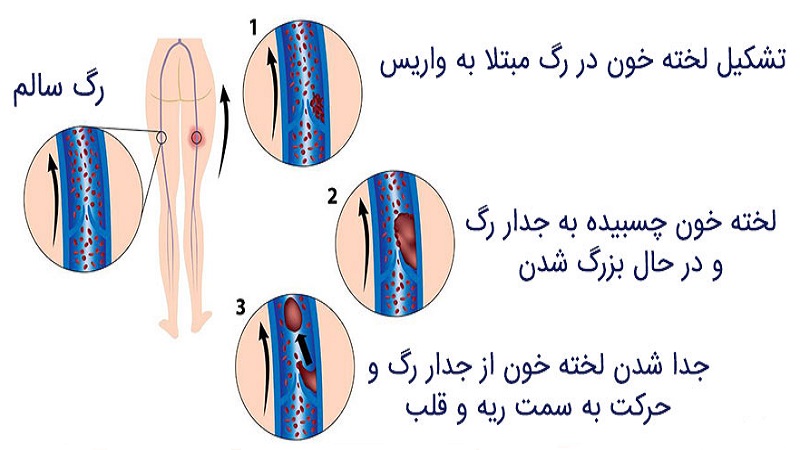 علل بیماری ترومبوز سیاهرگی عمقی (DVT) | دکتر مهرداد طاهریون بهترین متخصص واریس اصفهان