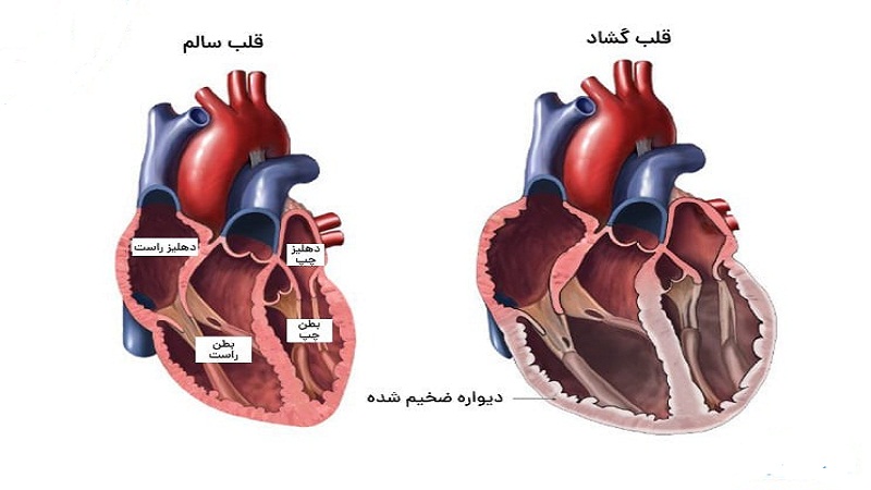 علائم گشاد شدن قلب | دکتر مهرداد طاهریون متخصص قلب اصفهان