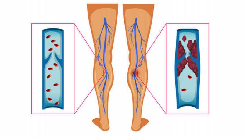 لخته شدن خون در پا در سفر | بهترین متخصص واریس اصفهان - متخصص قلب اصفهان