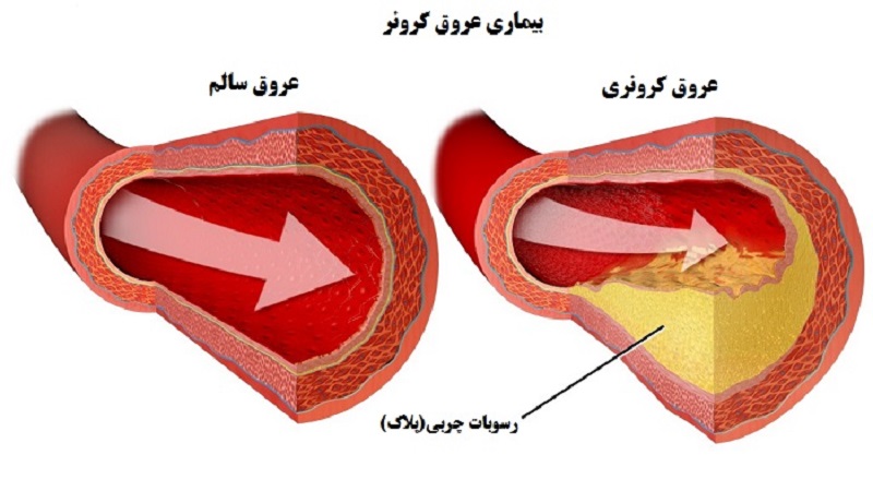 عامل‌های خطر ابتلا به بیماری گرفتگی عروق کرونری | بهترین متخصص واریس اصفهان - متخصص قلب اصفهان