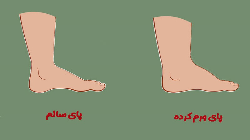 علت ورم پا در سالمندان (قسمت1) | بهترین متخصص واریس اصفهان - متخصص قلب اصفهان