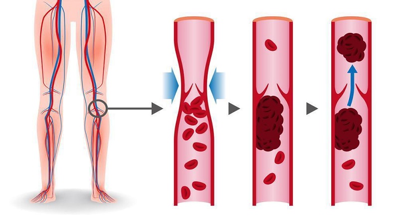 عوارض و خطرات لخته‌های عمقی (DVT) | بهترین متخصص واریس اصفهان - متخصص قلب اصفهان