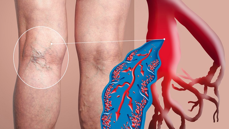 عوارض و خطرات لخته‌های عمقی (DVT) | بهترین متخصص واریس اصفهان - متخصص قلب اصفهان