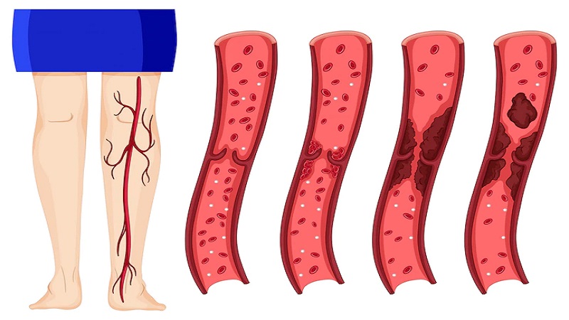 لخته‌های عمقی | بهترین متخصص واریس اصفهان - متخصص قلب اصفهان