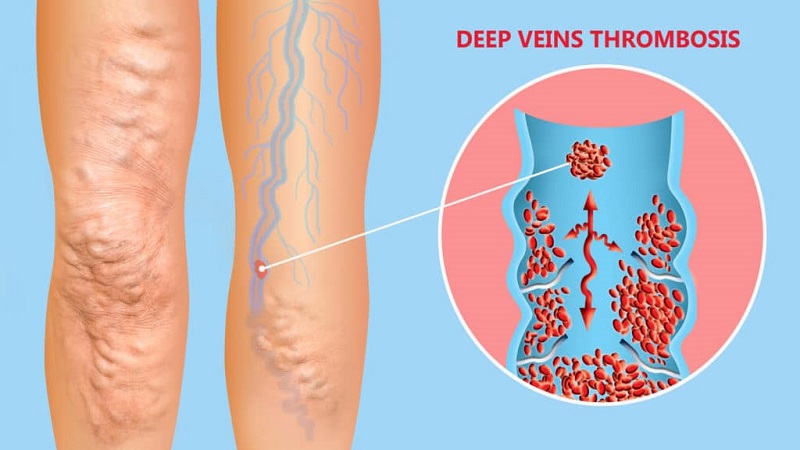 اقدامات درمانی لخته‌های عمقی (DVT) |بهترین متخصص واریس اصفهان - متخصص قلب اصفهان